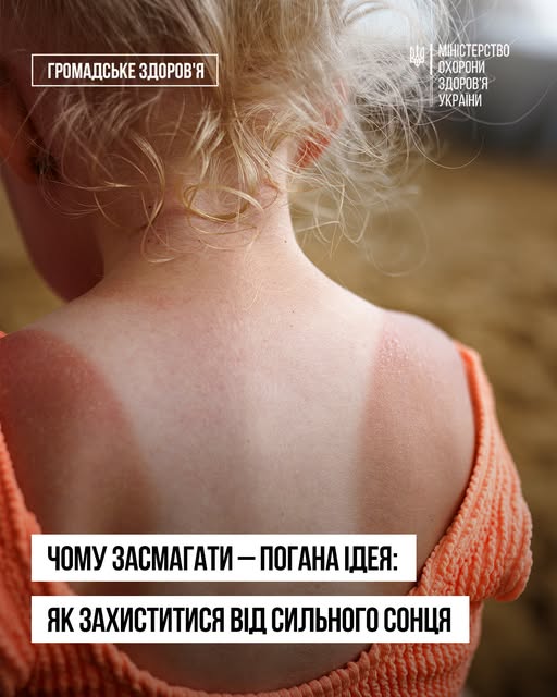Зображення дитини зі світлим волоссям, яка стоїть спиною, у помаранчевому топі з тонкими бретелями. На плечах і верхній частині спини видно сонячні опіки. Тло — відкрита місцевість із піском чи землею. Текст українською: «Громадське здоров’я. Міністерство охорони здоров’я України. Чому засмагати — погана ідея: як захиститися від сильного сонця»